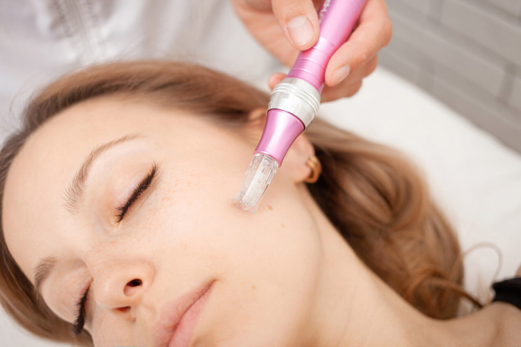 microneedling