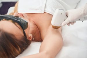 laser hair removal