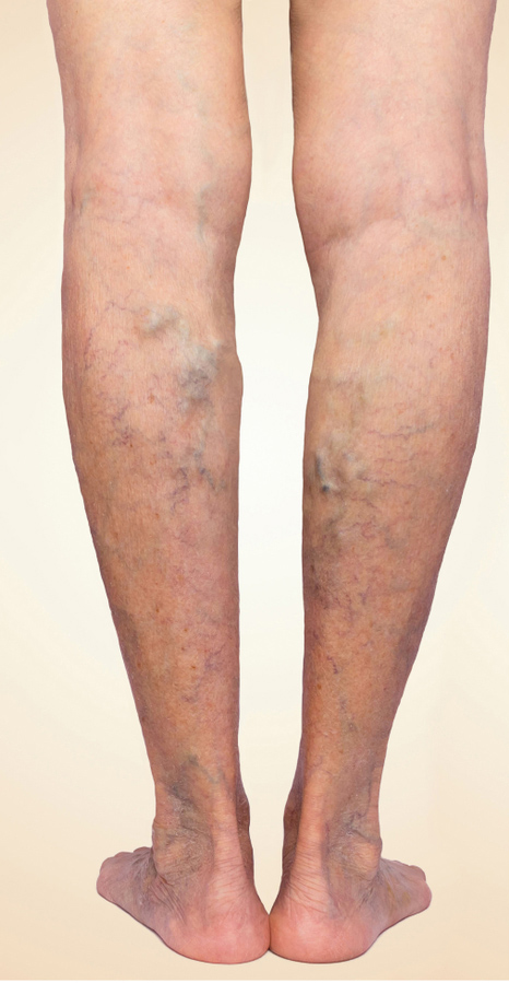 Treatment,Of,Varicose,Before,And,After ,Varicose,Veins,On,The