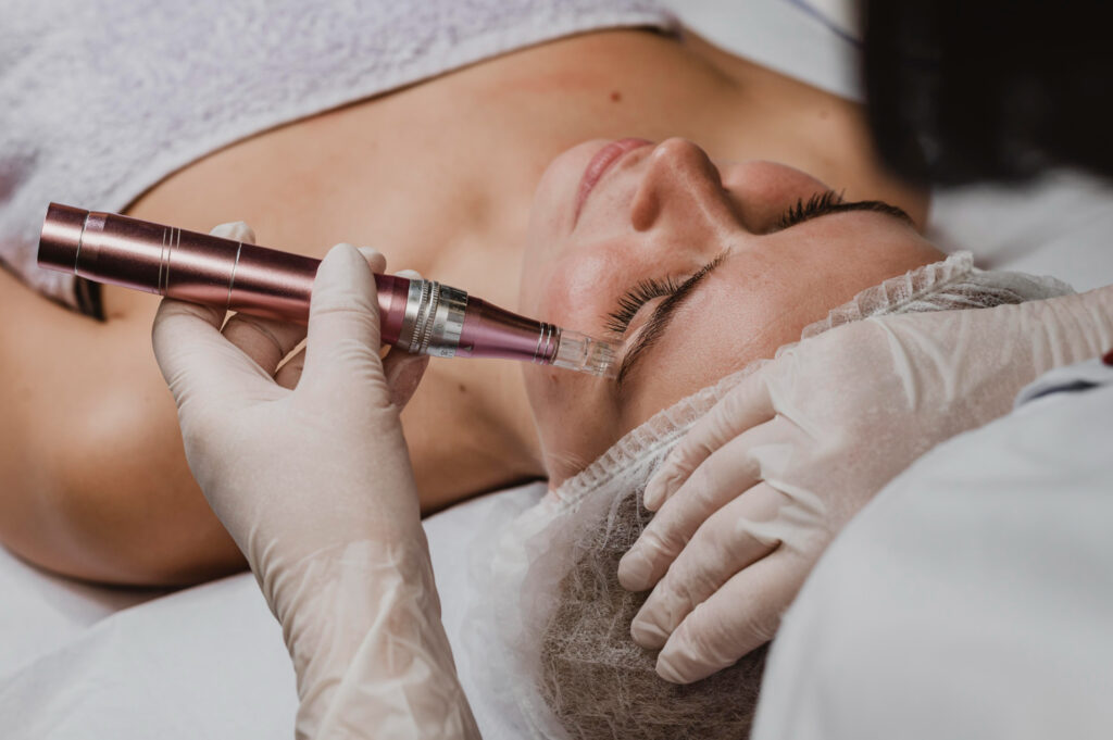 microneedling