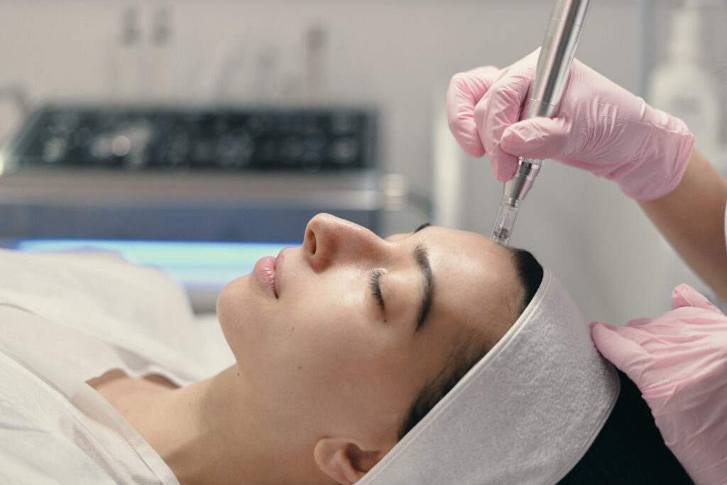 microneedling