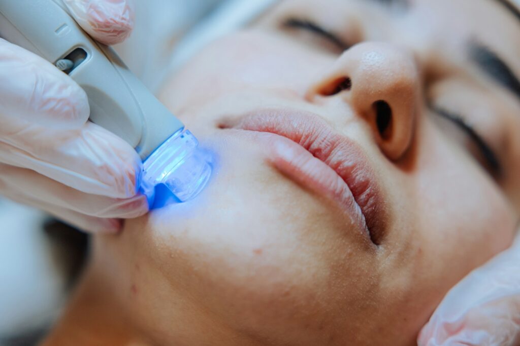 laser treatments